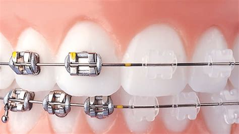 brackets ceramicos vs metalicos|Brackets Cerámicos Vs Metálicos: 7 Diferencias .